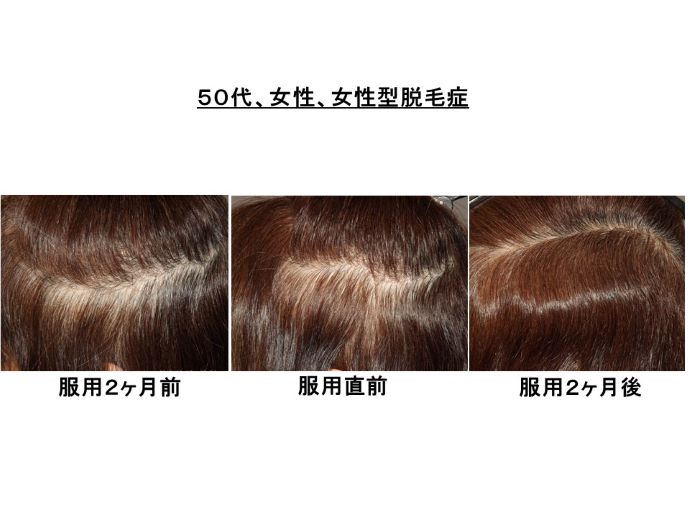 円形脱毛症　病院
